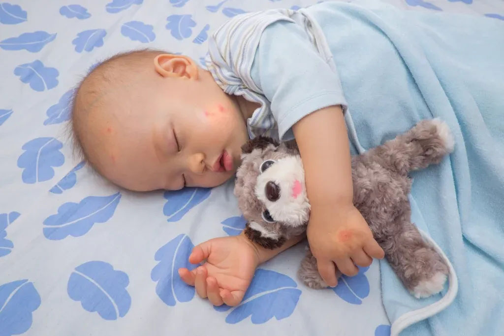 Sleeping baby holding a plush toy with visible skin rashes on arm and face.